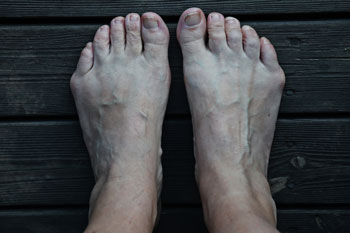 Bunions treatment bunions treatment in the Kings County, NY: Brooklyn, Queens County, NY: Queens, Long Island City, Flushing, Jamaica, Astoria, Elmhurst, Ridgewood, New York County, NY: Manhattan, Bronx County, NY: Bronx, Richmond County, NY: Staten Island areas