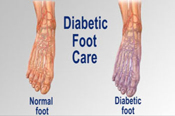 Diabetic Foot Care diabetic foot care in the Kings County, NY: Brooklyn, Queens County, NY: Queens, Long Island City, Flushing, Jamaica, Astoria, Elmhurst, Ridgewood, New York County, NY: Manhattan, Bronx County, NY: Bronx, Richmond County, NY: Staten Island areas