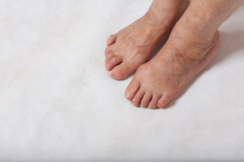 hammertoes treatment in the Kings County, NY: Brooklyn, Queens County, NY: Queens, Long Island City, Flushing, Jamaica, Astoria, Elmhurst, Ridgewood, New York County, NY: Manhattan, Bronx County, NY: Bronx, Richmond County, NY: Staten Island areas