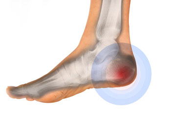 Heel pain treatment heel pain treatment in the Kings County, NY: Brooklyn, Queens County, NY: Queens, Long Island City, Flushing, Jamaica, Astoria, Elmhurst, Ridgewood, New York County, NY: Manhattan, Bronx County, NY: Bronx, Richmond County, NY: Staten Island areas
