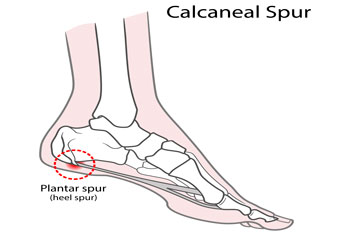 Heel spurs treatment heel spurs treatment in the Kings County, NY: Brooklyn, Queens County, NY: Queens, Long Island City, Flushing, Jamaica, Astoria, Elmhurst, Ridgewood, New York County, NY: Manhattan, Bronx County, NY: Bronx, Richmond County, NY: Staten Island areas