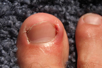 ingrown toenail treatment in the Kings County, NY: Brooklyn, Queens County, NY: Queens, Long Island City, Flushing, Jamaica, Astoria, Elmhurst, Ridgewood, New York County, NY: Manhattan, Bronx County, NY: Bronx, Richmond County, NY: Staten Island areas