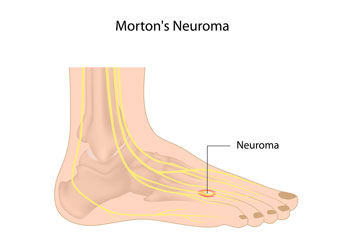 Neuromas treatment neuromas treatment in the Kings County, NY: Brooklyn, Queens County, NY: Queens, Long Island City, Flushing, Jamaica, Astoria, Elmhurst, Ridgewood, New York County, NY: Manhattan, Bronx County, NY: Bronx, Richmond County, NY: Staten Island areas