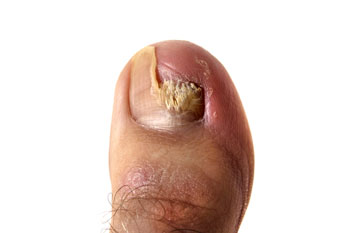 Toenail Fungus Treatment toenail fungus treatment in the Kings County, NY: Brooklyn, Queens County, NY: Queens, Long Island City, Flushing, Jamaica, Astoria, Elmhurst, Ridgewood, New York County, NY: Manhattan, Bronx County, NY: Bronx, Richmond County, NY: Staten Island areas