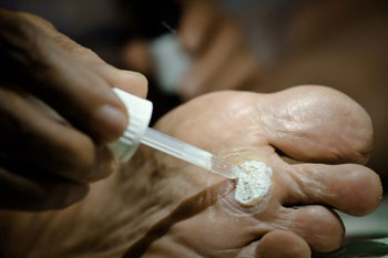 Plantar Warts Treatment in the Kings County, NY: Brooklyn, Queens County, NY: Queens, Long Island City, Flushing, Jamaica, Astoria, Elmhurst, Ridgewood, New York County, NY: Manhattan, Bronx County, NY: Bronx, Richmond County, NY: Staten Island areas